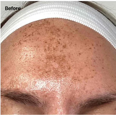 After Treatment