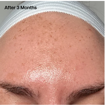 Before Treatment