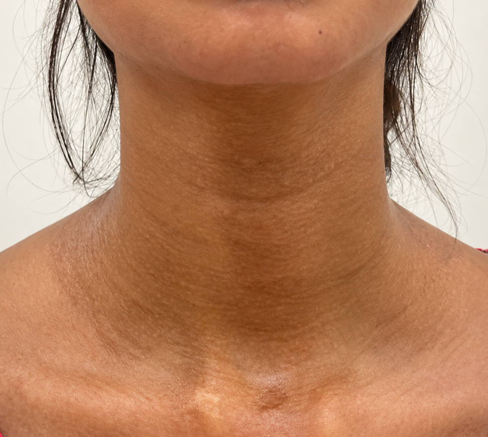 After Treatment