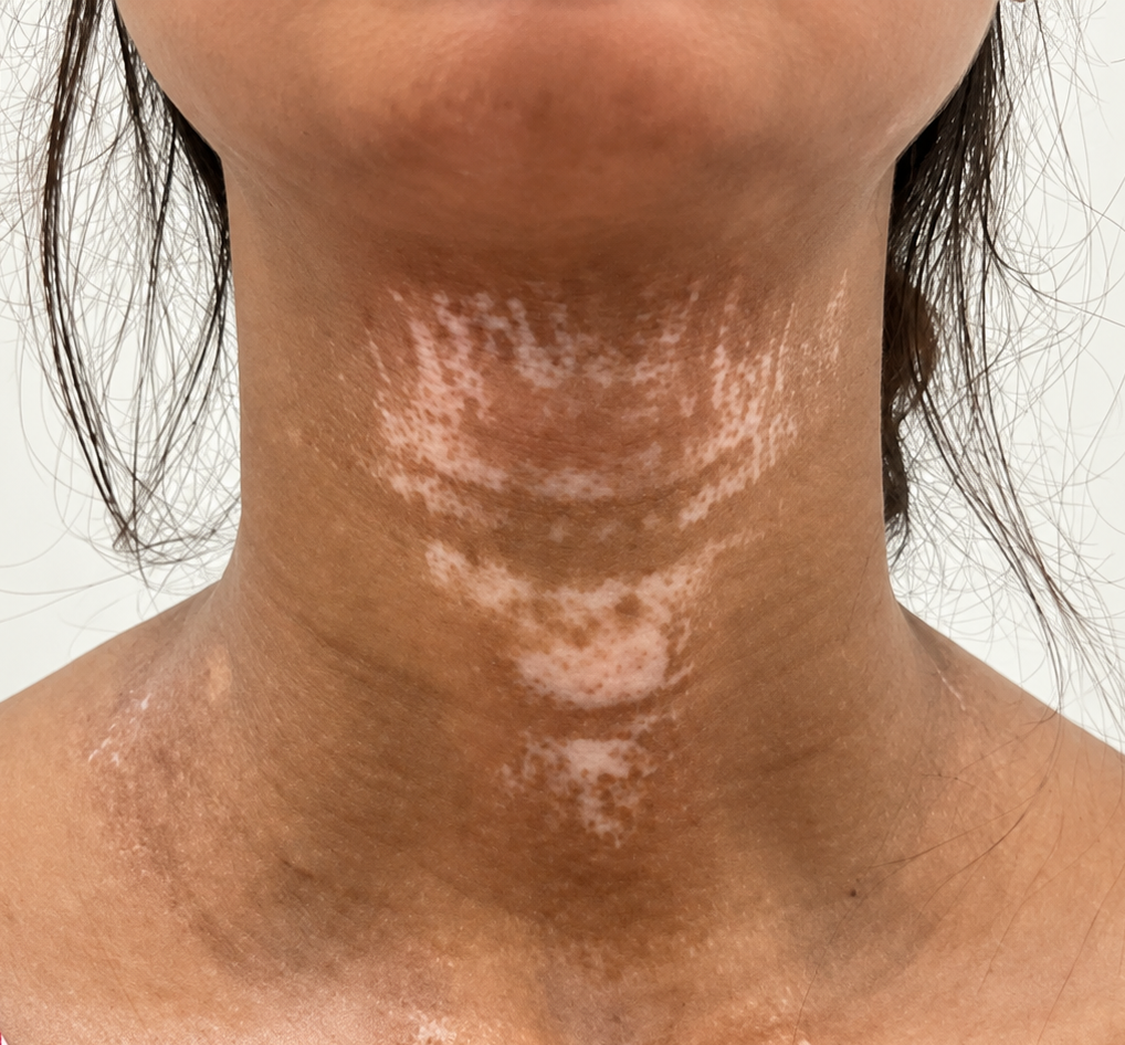 Before Treatment