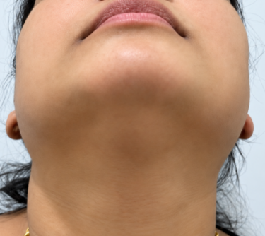 After Treatment