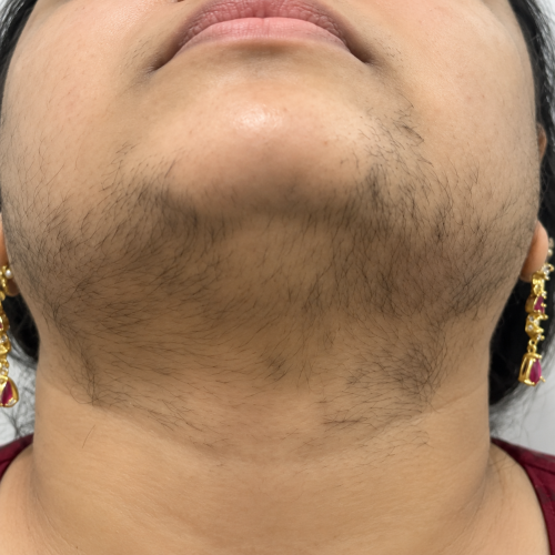 Before Treatment