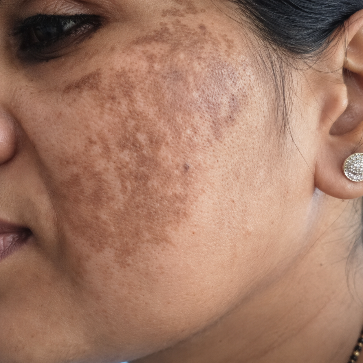 Before pigmentation treatment